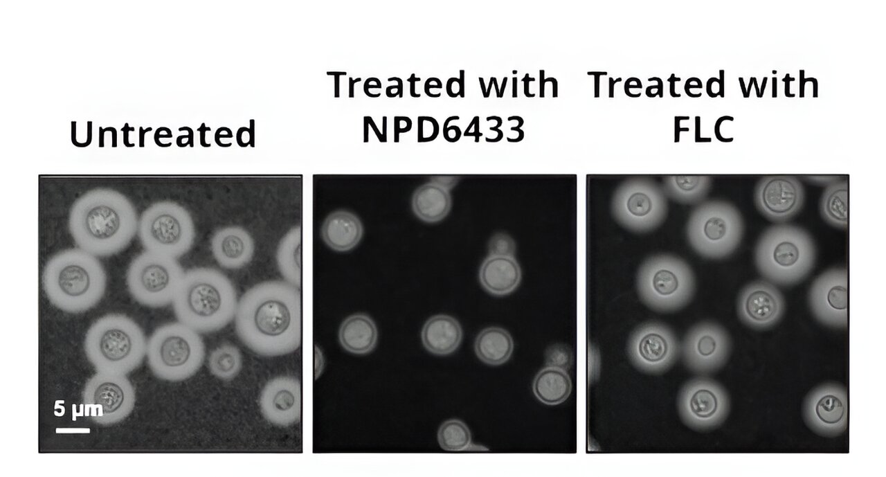 Breakthrough Treatment Unveiled to Combat Fungal Infections