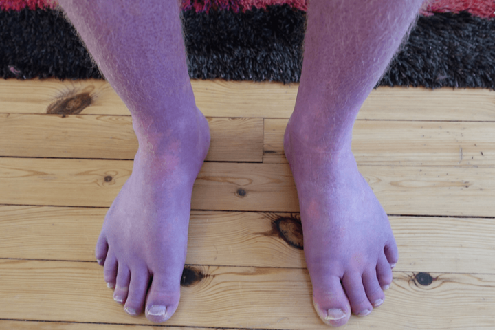 Man’s Legs Turn Purple in Rare Complication from Long Covid