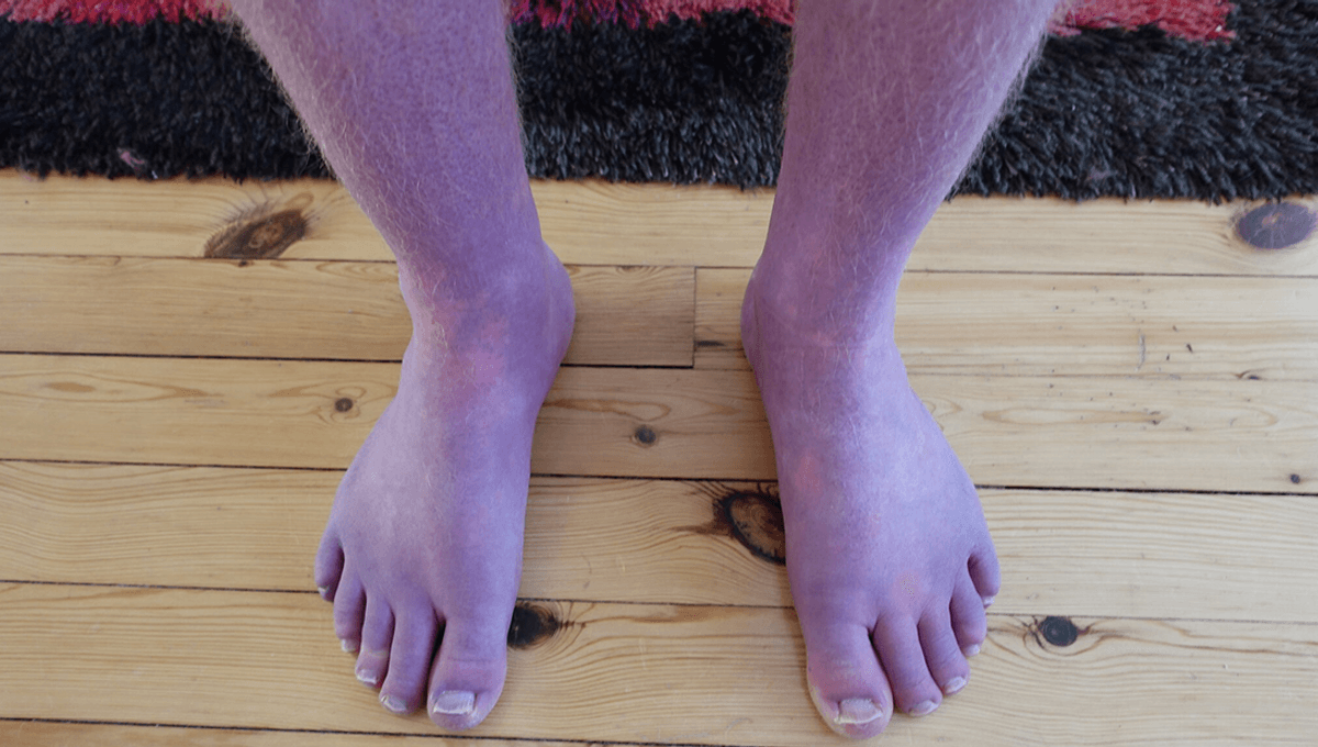Man’s Legs Turn Purple in Rare Complication from Long Covid