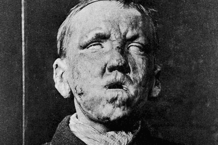 Leprosy Surges in Florida, Puzzling Experts