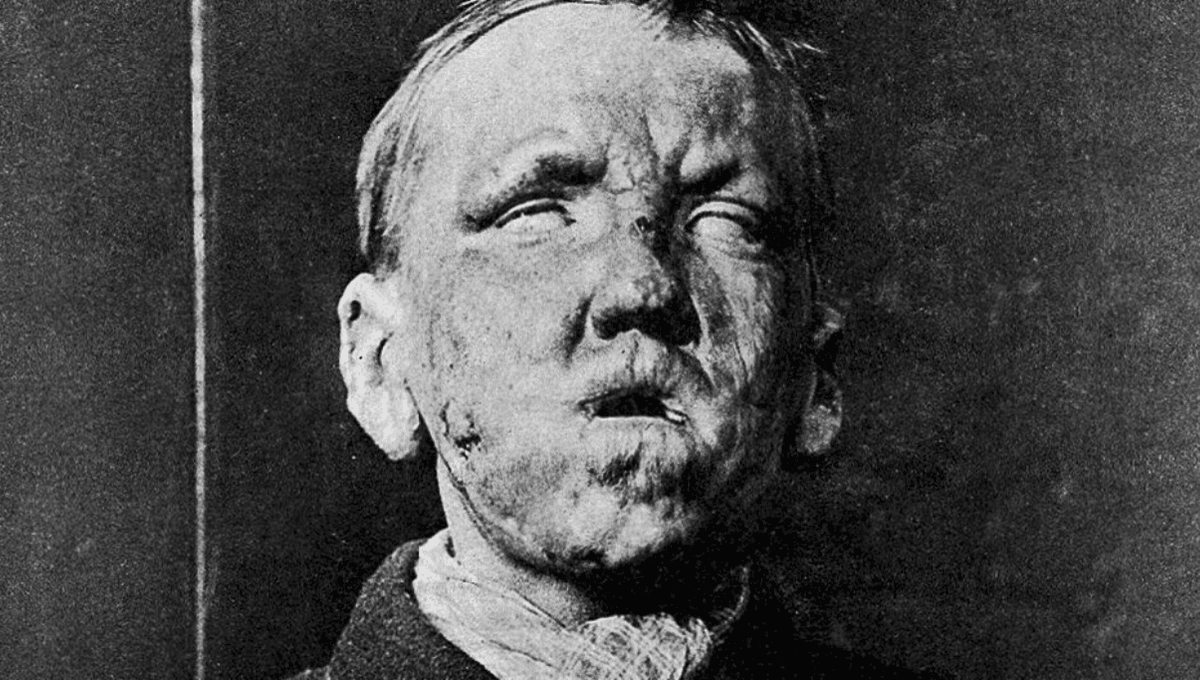 Leprosy Surges in Florida, Puzzling Experts