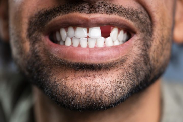 Tooth Regeneration Breakthrough May Pave Way for Living Fillings