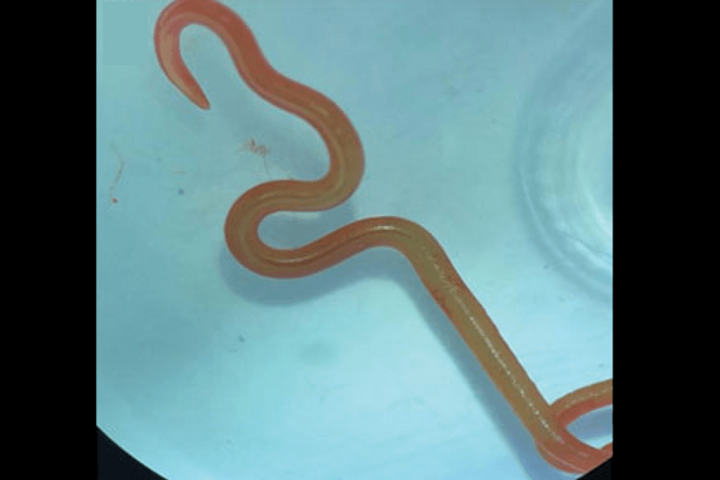 8-Centimeter Parasitic Worm Extracted Alive From Woman’s Brain In Unprecedented Medical Breakthrough
