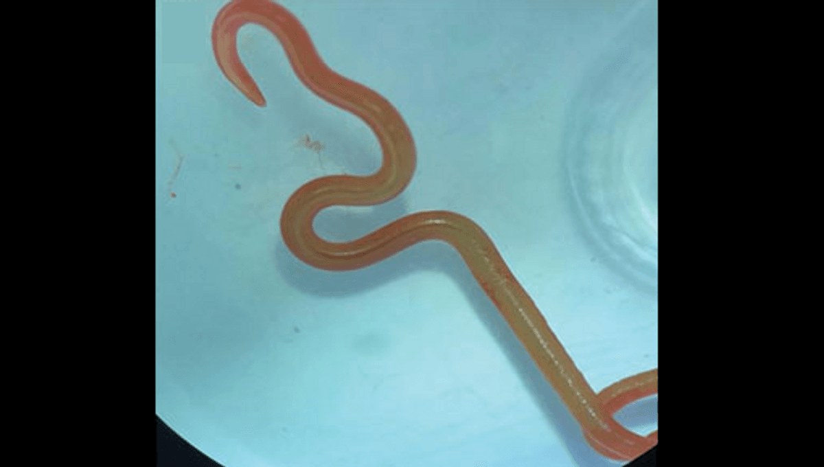 8-Centimeter Parasitic Worm Extracted Alive From Woman’s Brain In Unprecedented Medical Breakthrough
