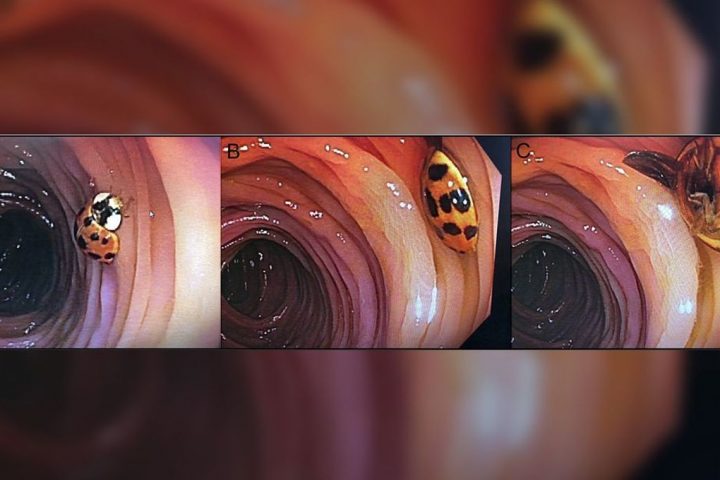 Ladybug Makes Unexpected Appearance During 59-Year-Old Man’s Colonoscopy