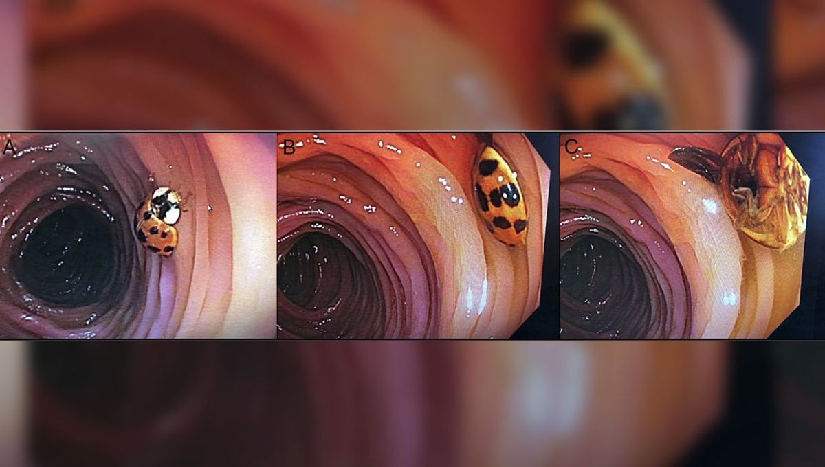 Ladybug Makes Unexpected Appearance During 59-Year-Old Man’s Colonoscopy