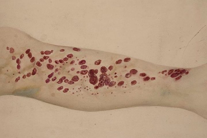 Ancient Disease Resurfaces in Certain Regions of the USA