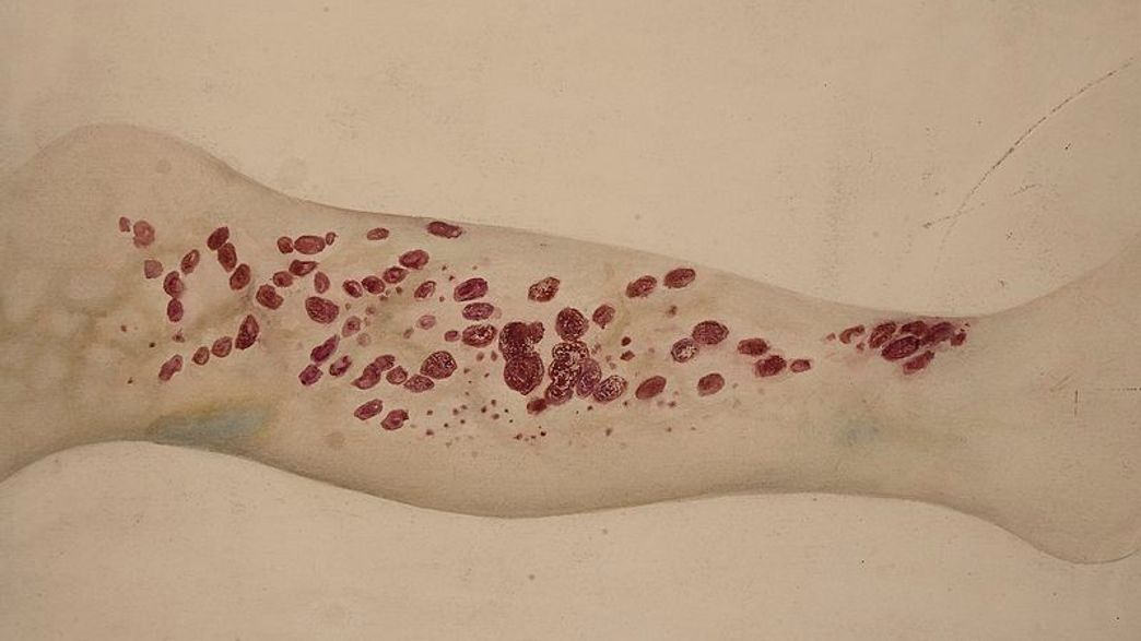 Ancient Disease Resurfaces in Certain Regions of the USA