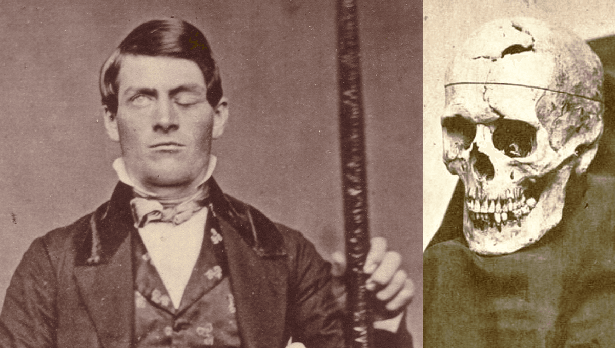 The Revolutionary Impact of Phineas Gage’s Skewered Brain on Medical Science