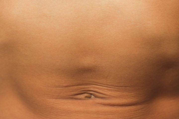 Bump Above Belly Button Could Indicate Epigastric Hernia