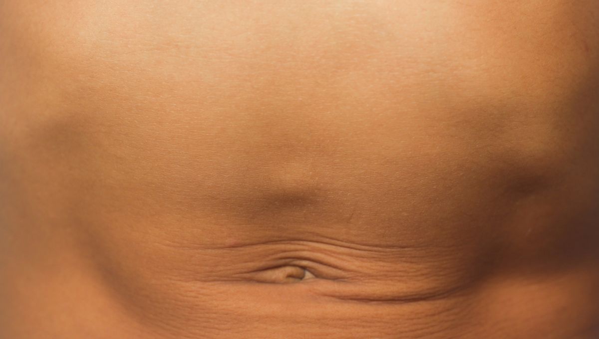 Bump Above Belly Button Could Indicate Epigastric Hernia
