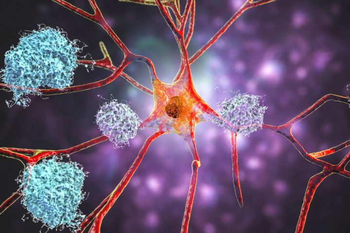 Leading Alzheimer’s Theory Challenged as Another Drug Fails Trials