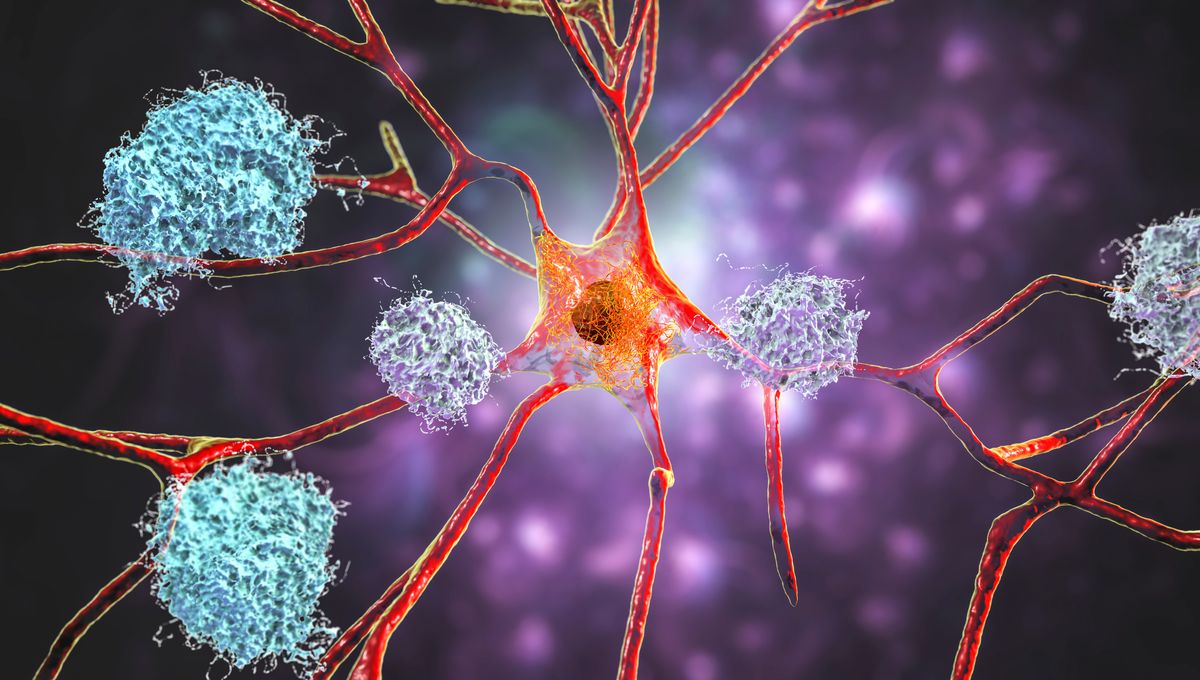 Leading Alzheimer’s Theory Challenged as Another Drug Fails Trials